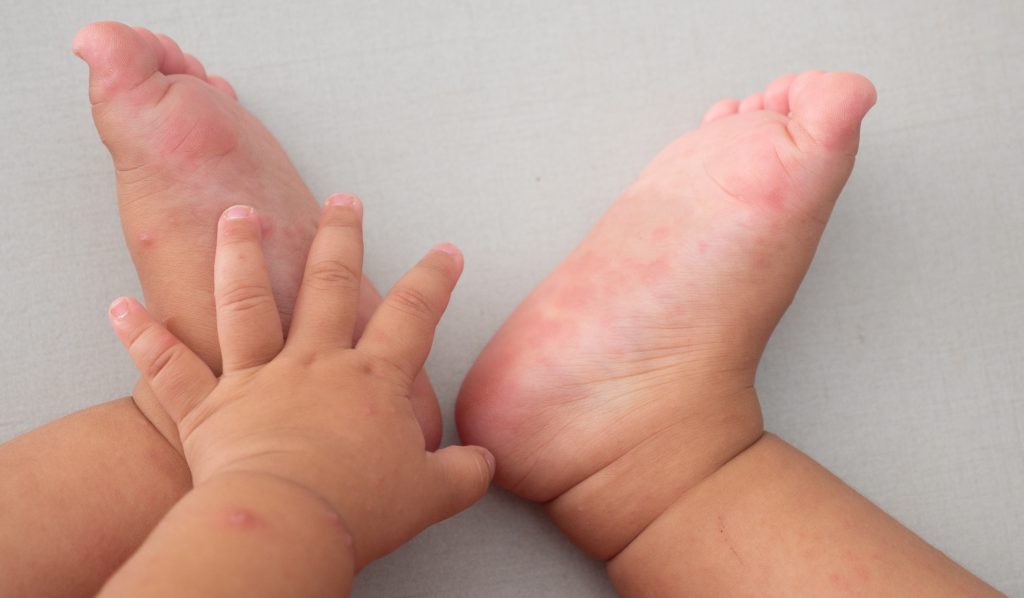 Bebeklerde El Ayak Hastalığı