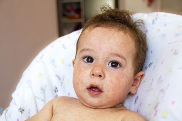 Bebeklerde En Sık Rastlanan 8 Cilt Hastalığı